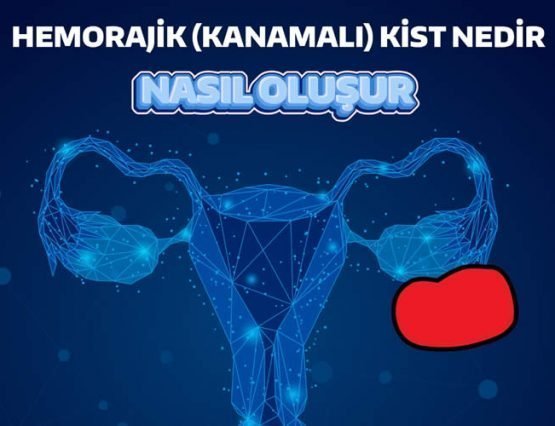 hemorajik kist nedir